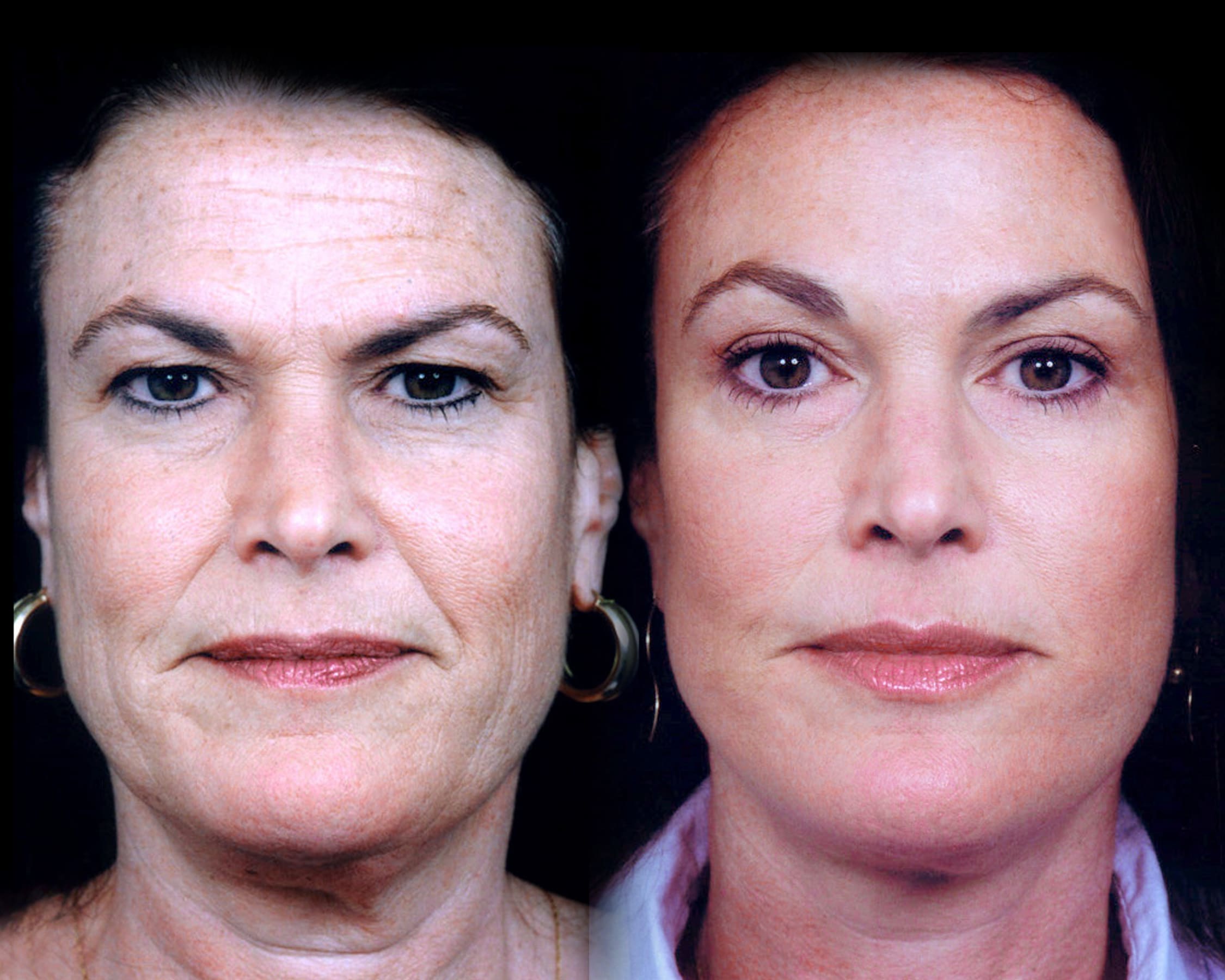 Facelift 1 Front Dr. John Shamoun – Dubai Plastic and Cosmetic Surgeon"
