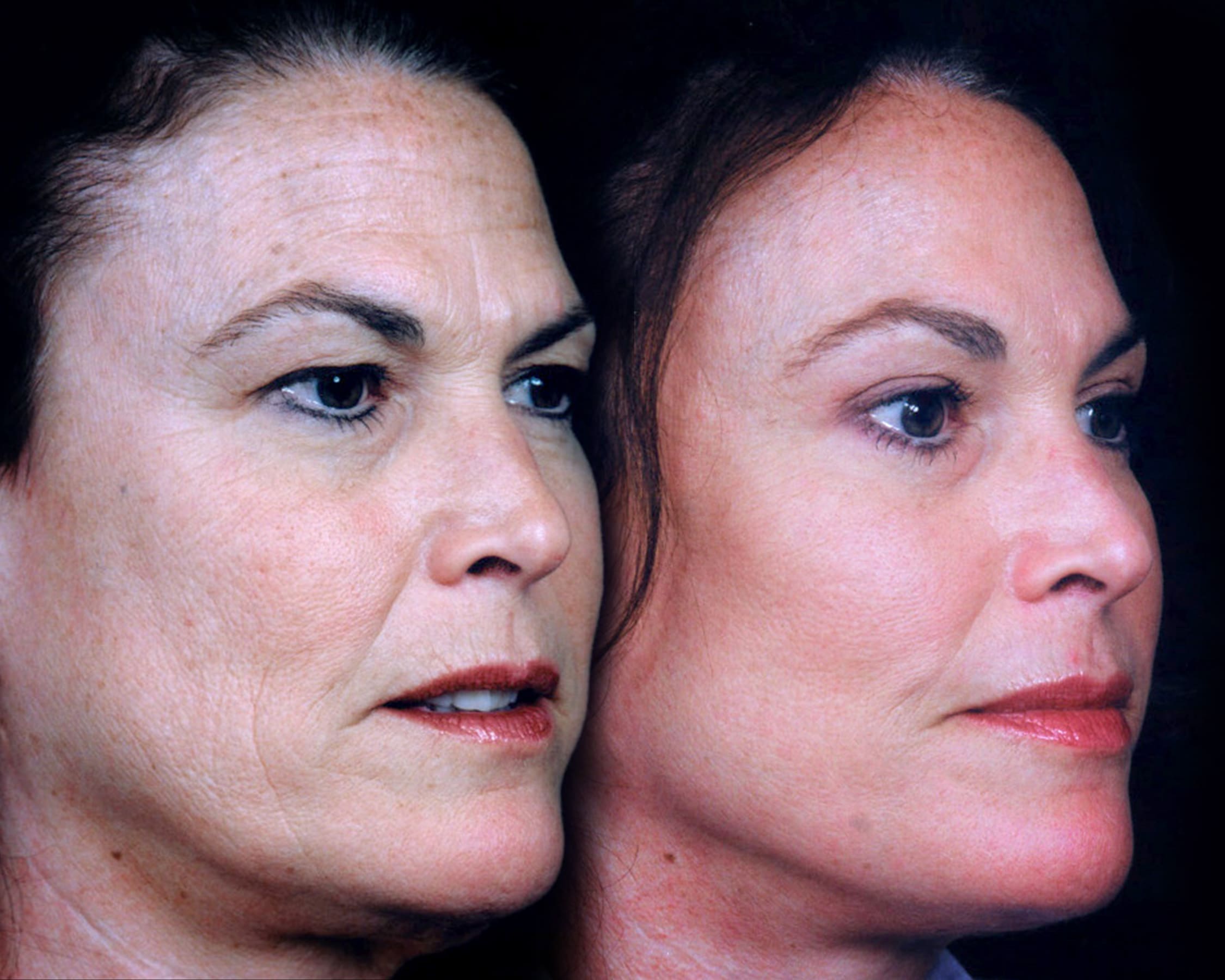 Facelift 1 Side Dr. John Shamoun – Dubai Plastic and Cosmetic Surgeon"