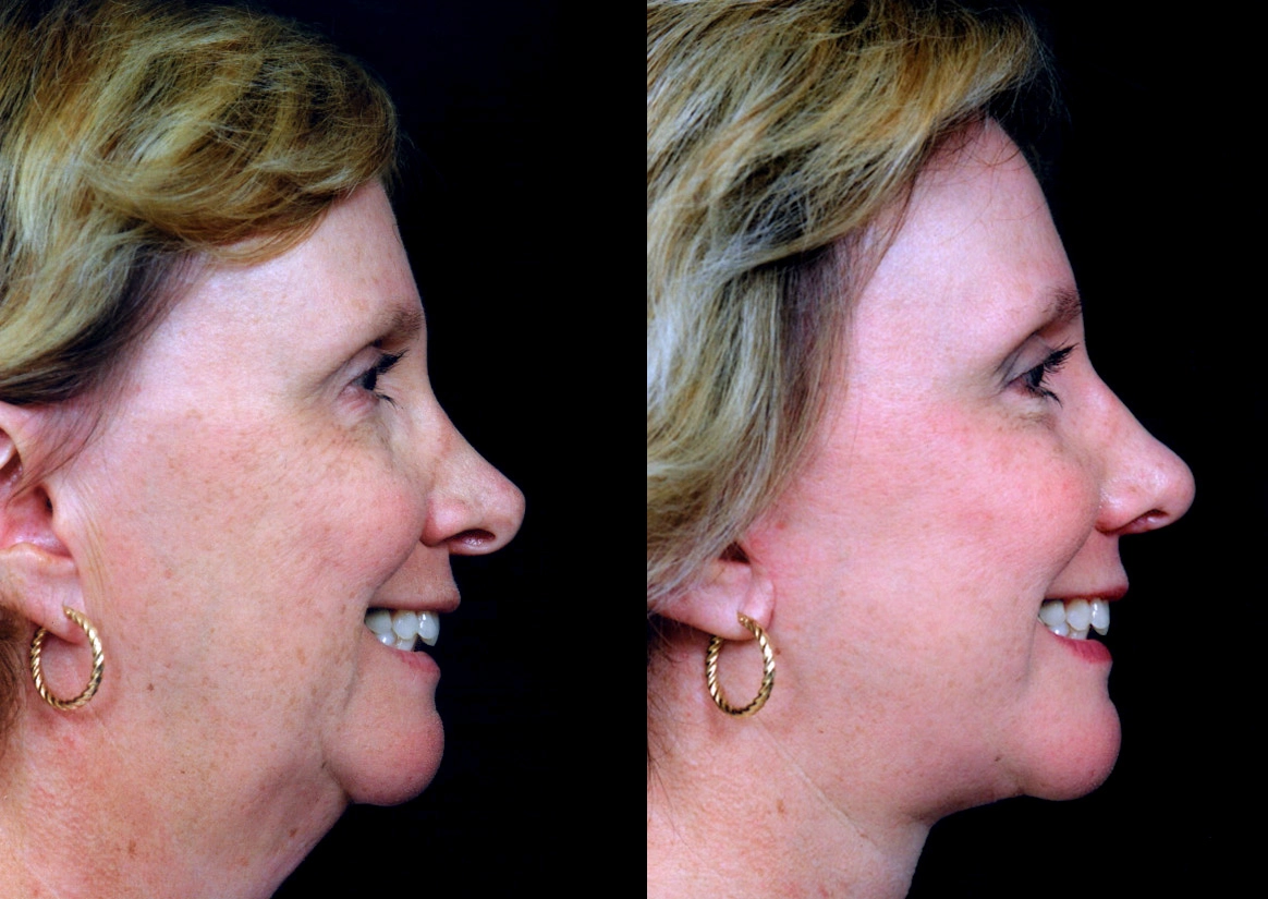 Facelift Dubai Cosmetic Facelift Case 5604-2