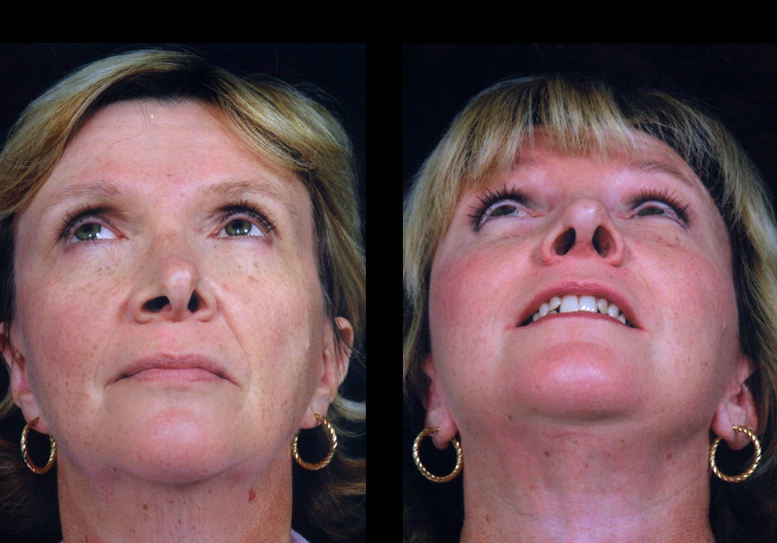 Facelift Dubai Cosmetic Facelift Case 5604-3