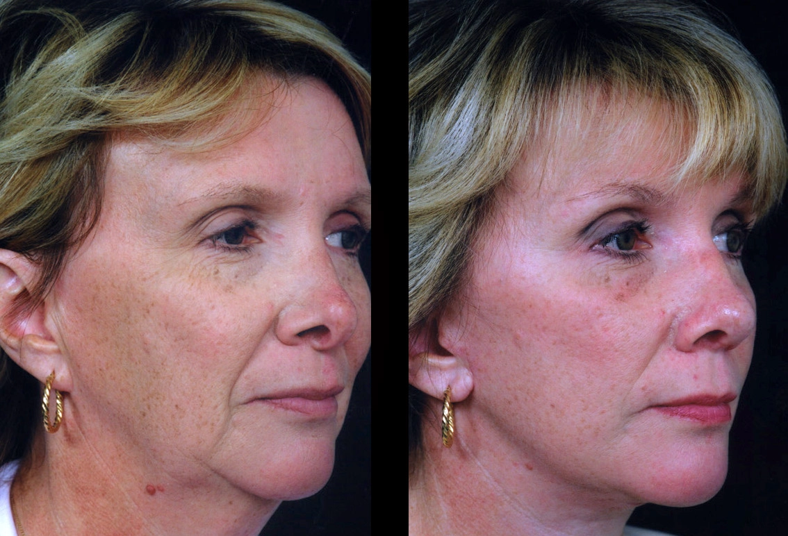 Facelift Dubai Cosmetic Facelift Case 5604-4