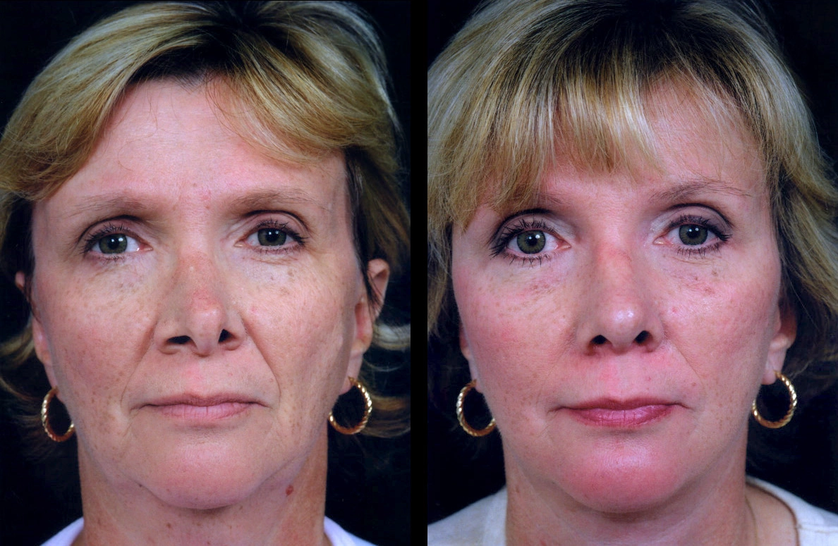 Facelift Dubai Cosmetic Facelift Case 5604