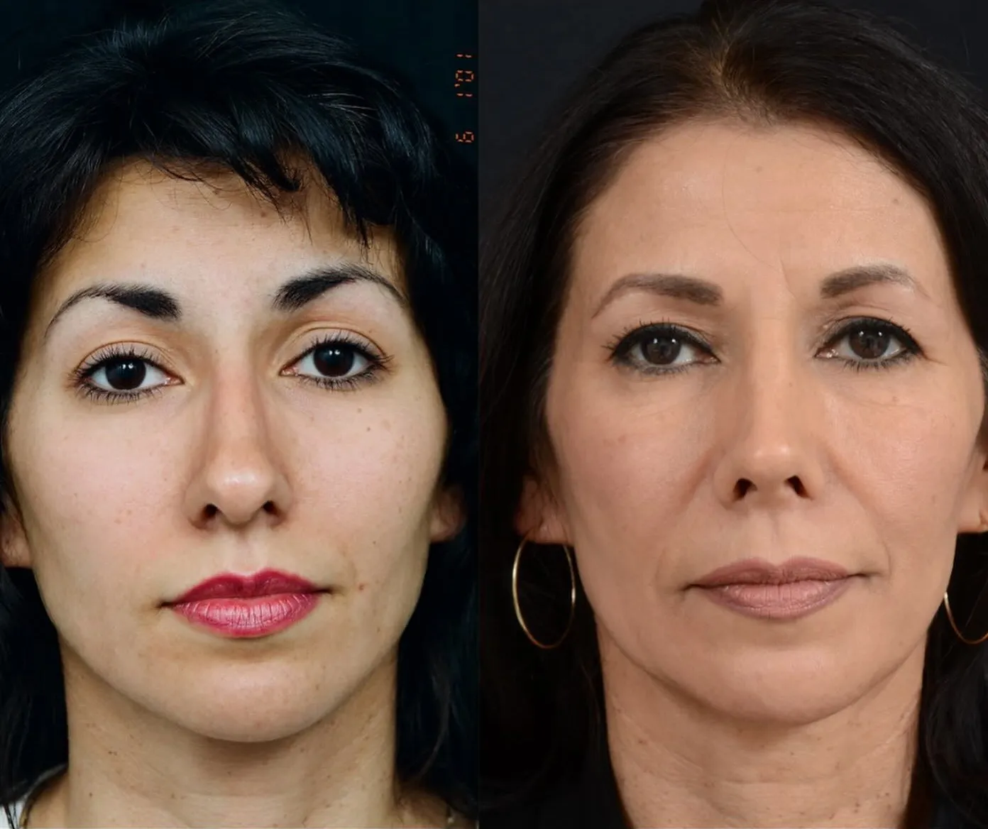 Rhinoplasty