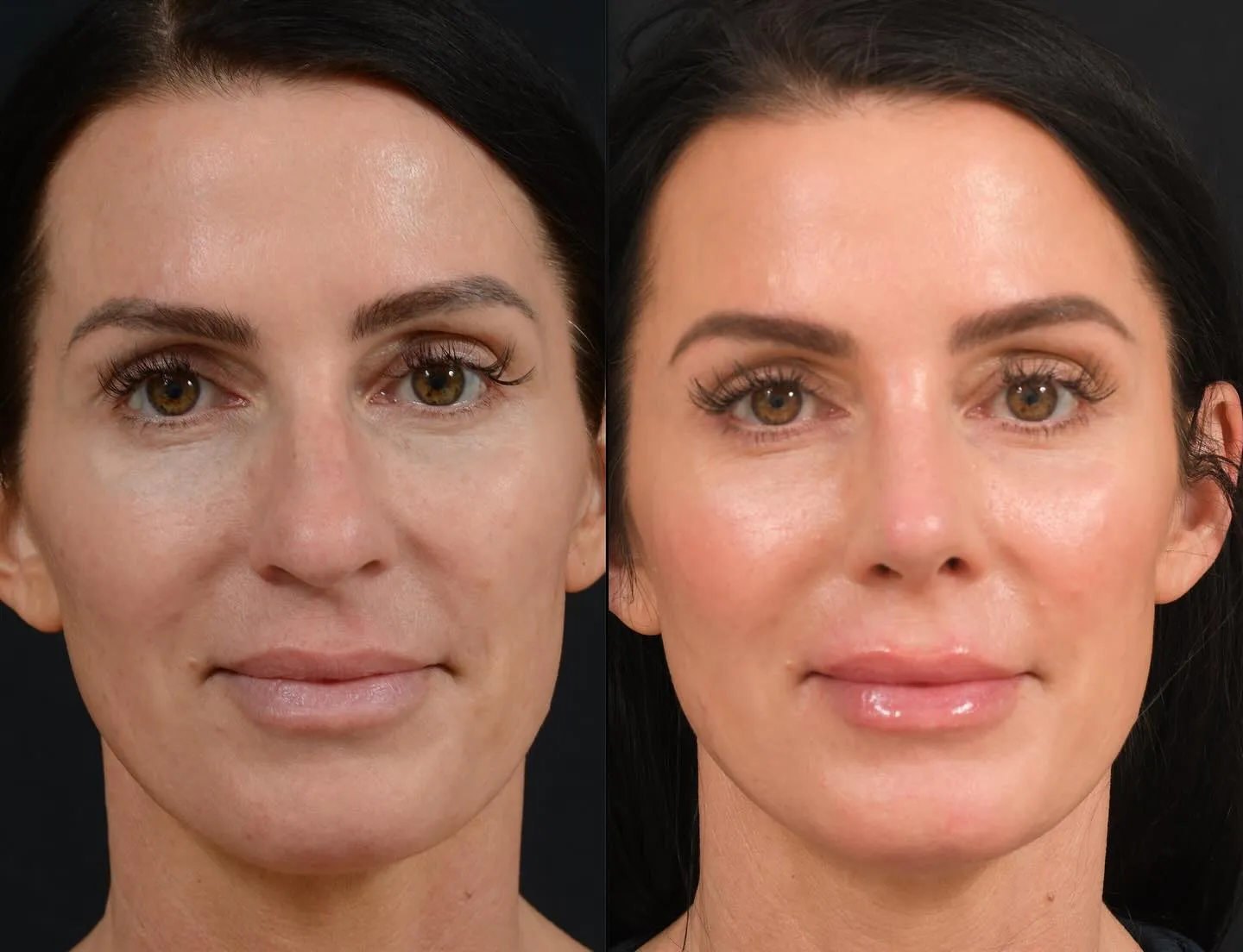 Rhinoplasty