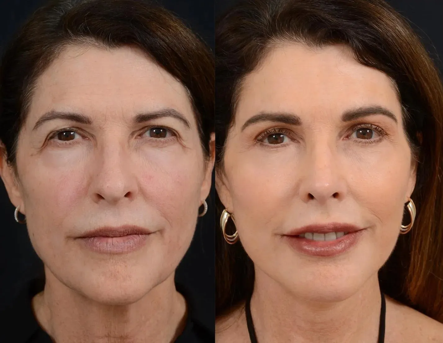 Facial Rejuvenation