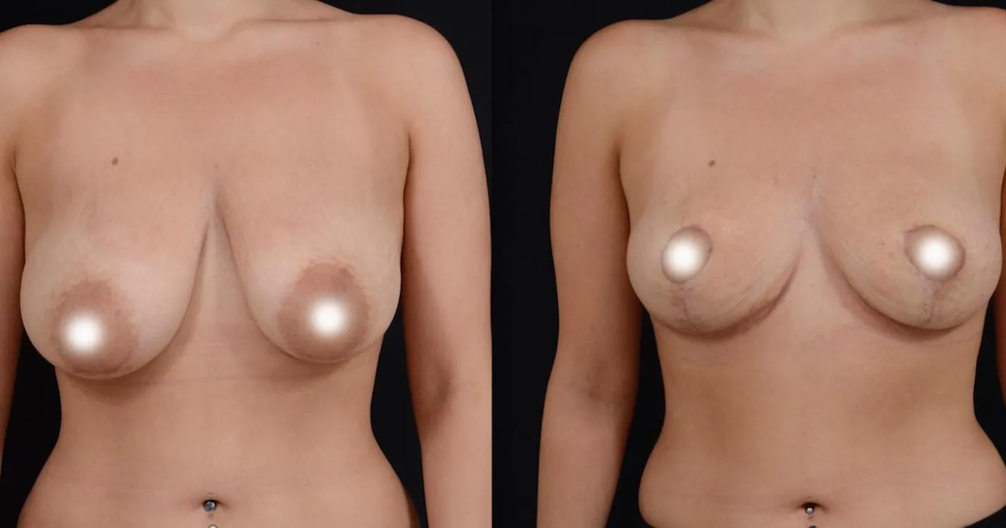 Natural Breast Lift