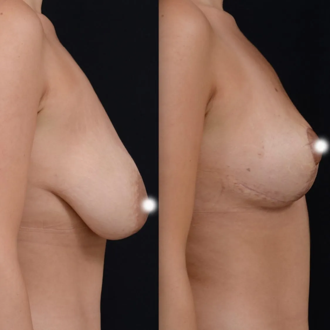 Natural Breast Lift