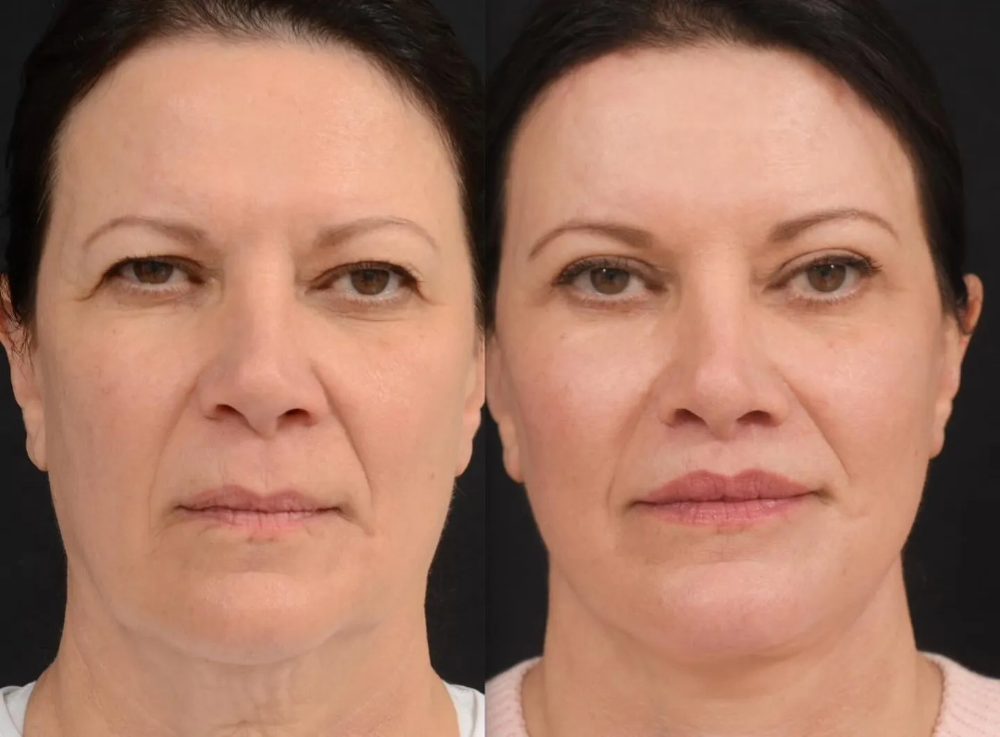 Facelift, Neck Lift & Eyelid Surgery