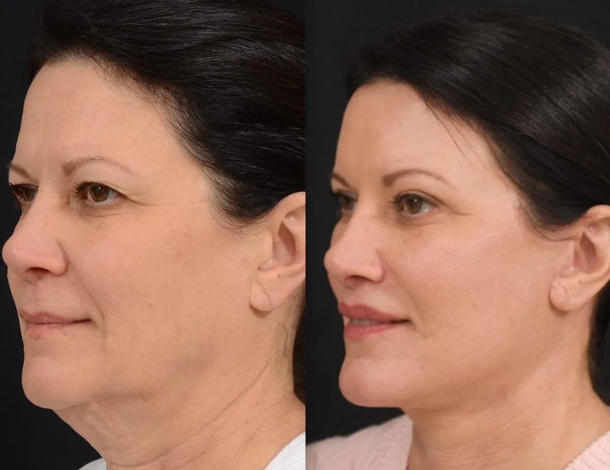 Facelift, Neck Lift & Eyelid Surgery