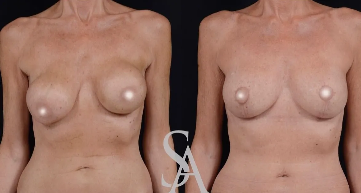 Breast Implant Revision & Lift
