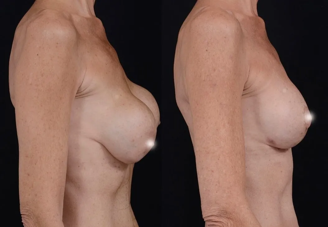 Breast Implant Revision & Lift