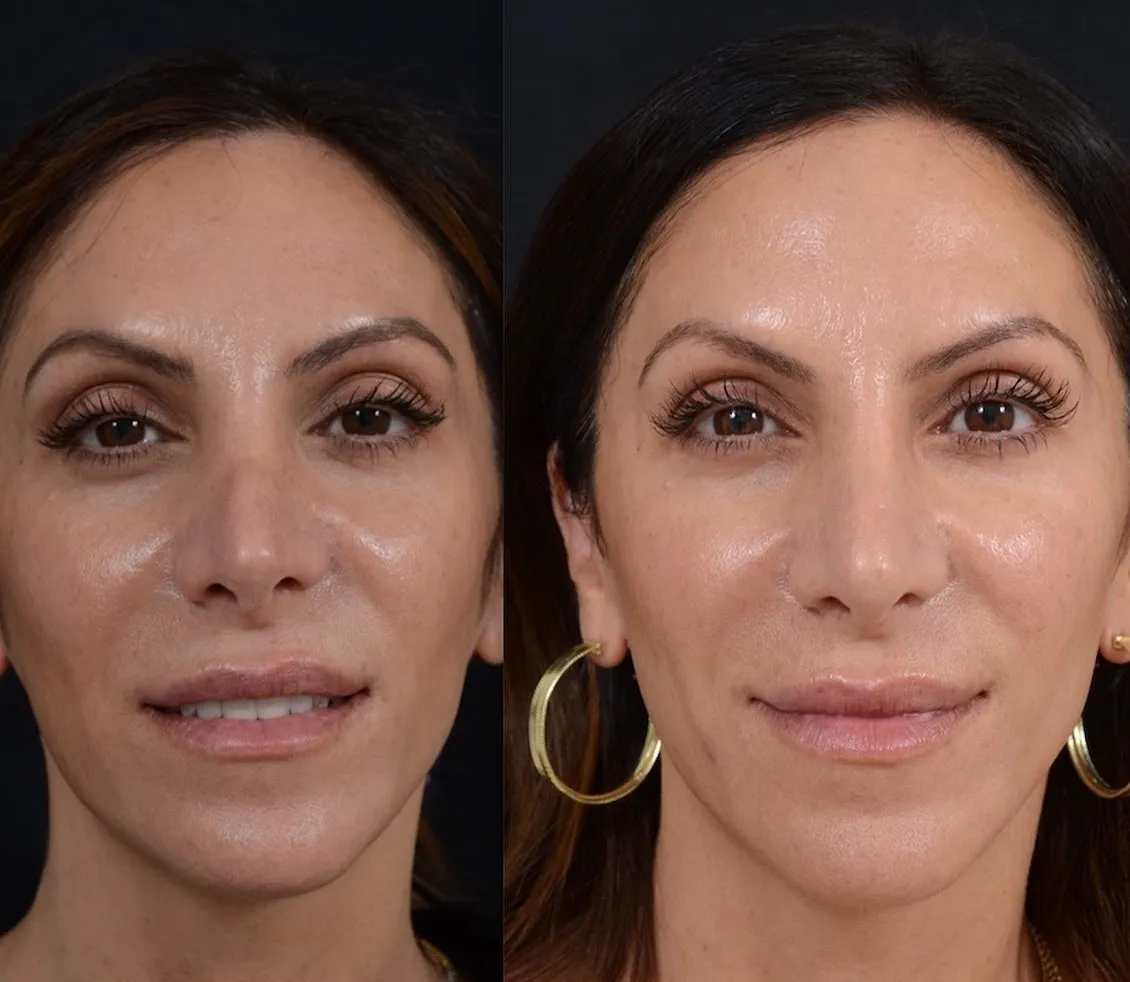 Symmetry Rhinoplasty Case 5938
