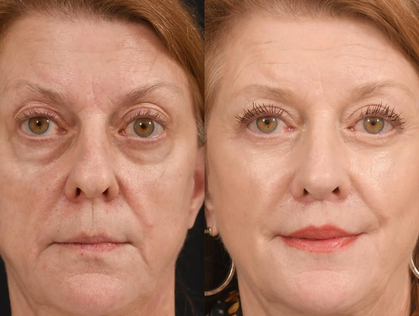 Midface & Lip Lift