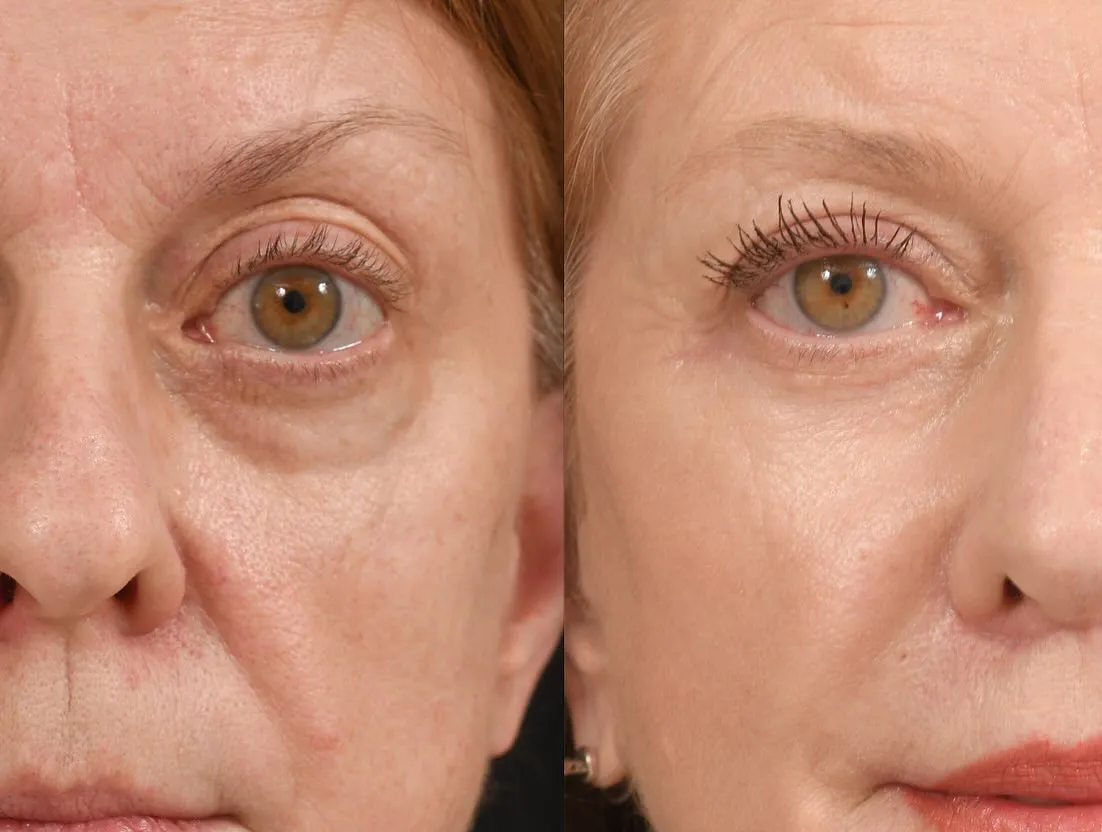 Midface & Lip Lift