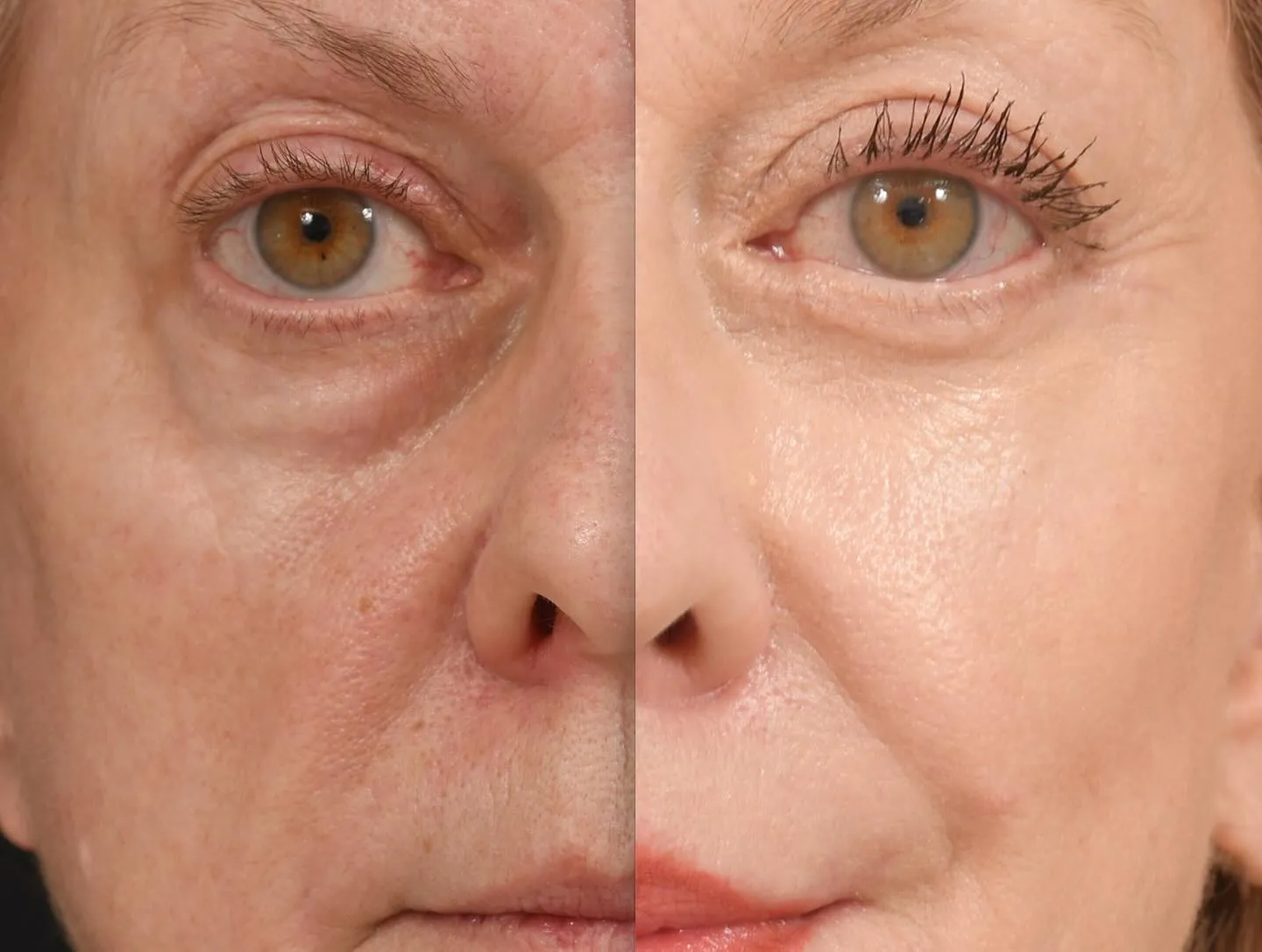 Midface & Lip Lift