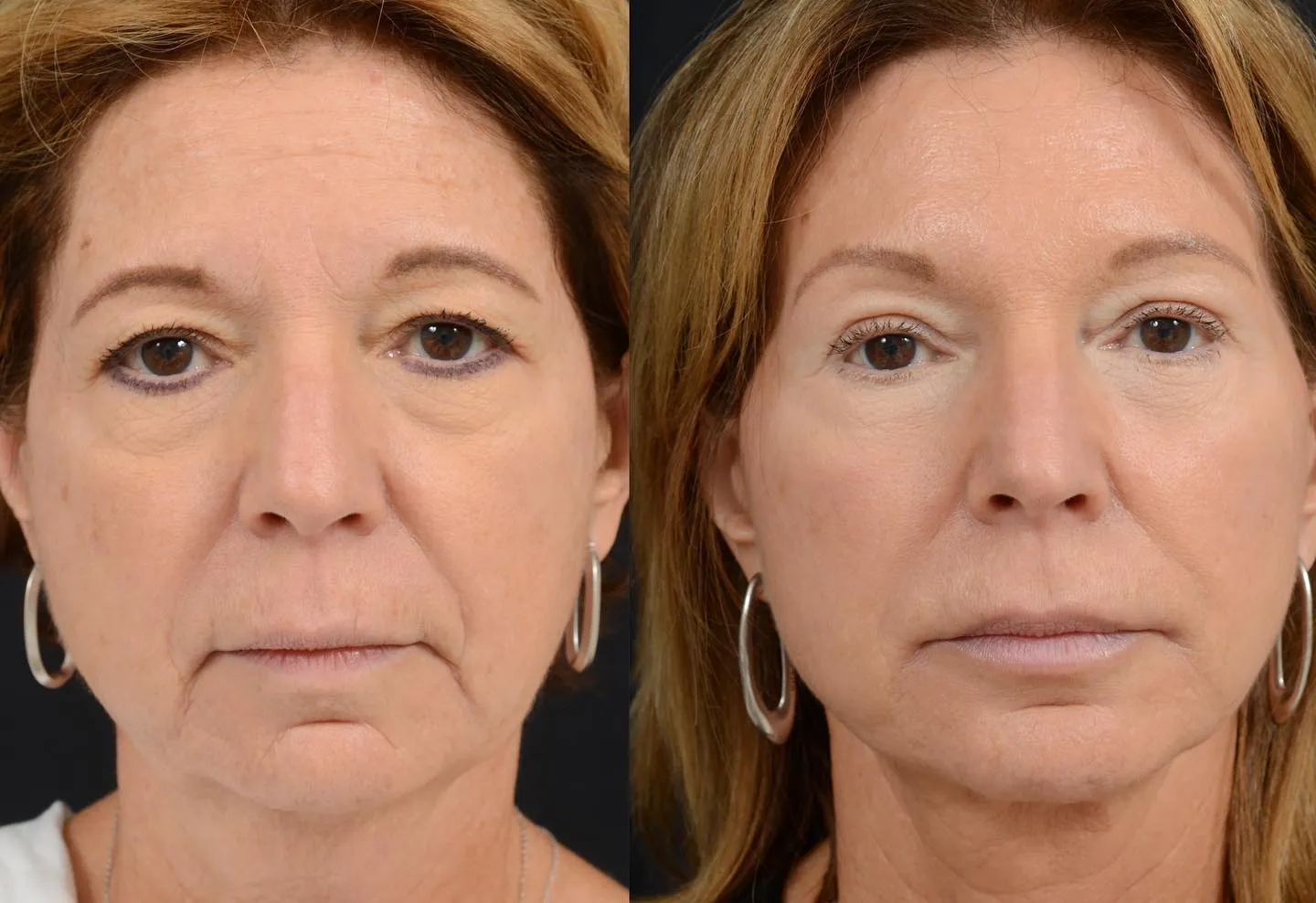 Face & Neck Lift with Blepharoplasty