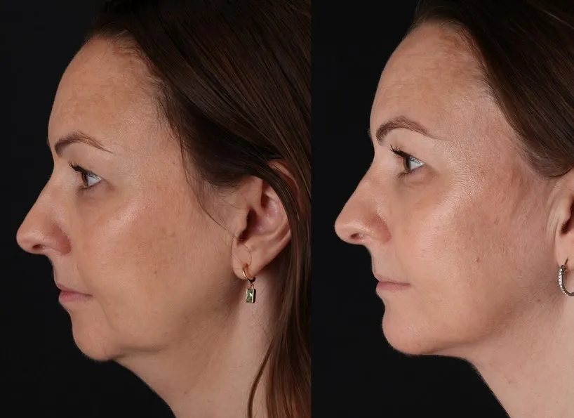 Chin Implant & Neck Liposuction