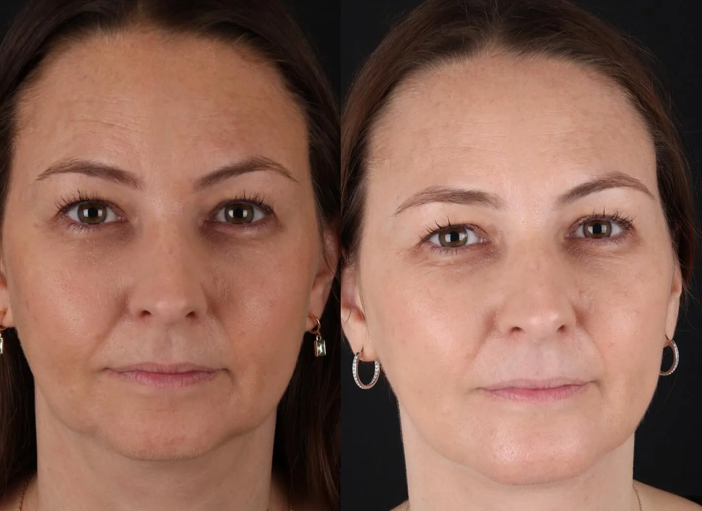 Chin Implant & Neck Liposuction