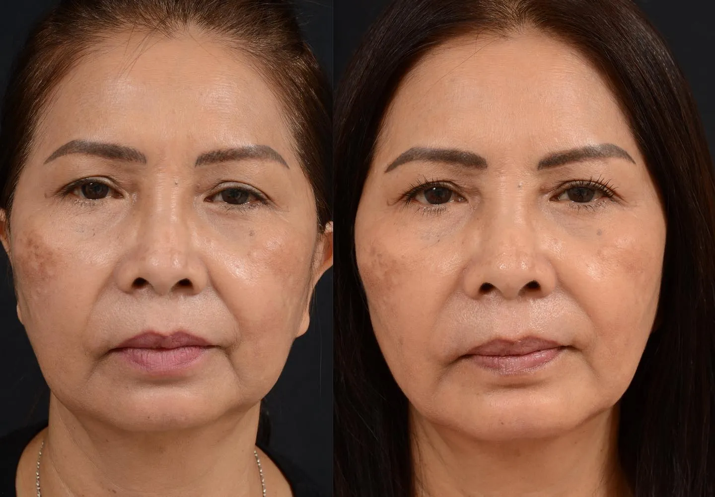 Minimal Facial Rejuvenation