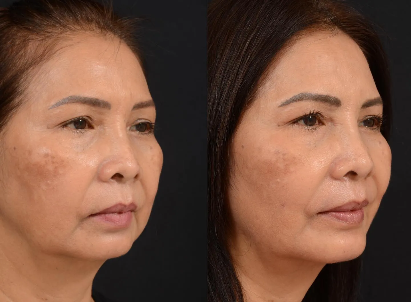 Minimal Facial Rejuvenation