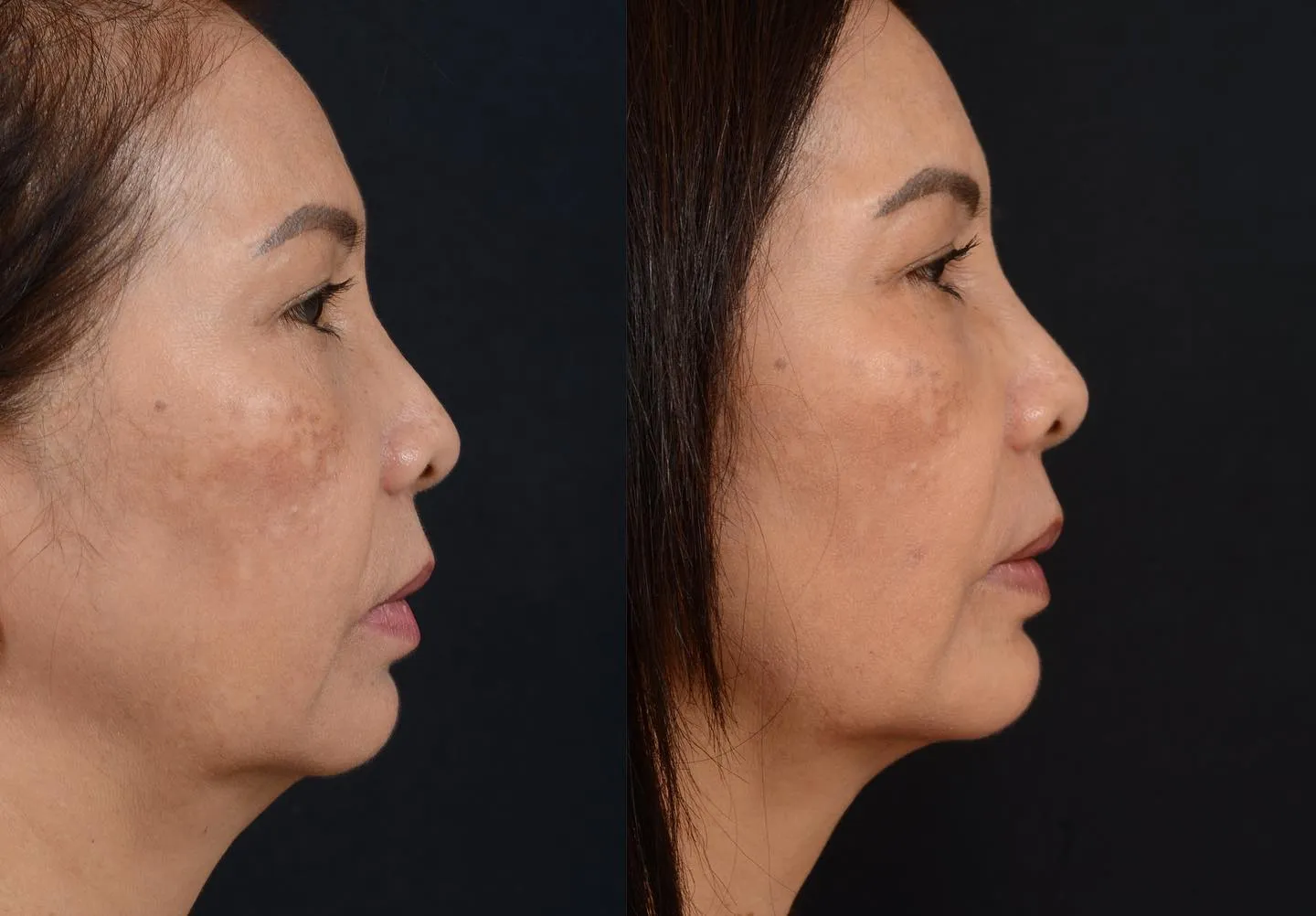 Minimal Facial Rejuvenation
