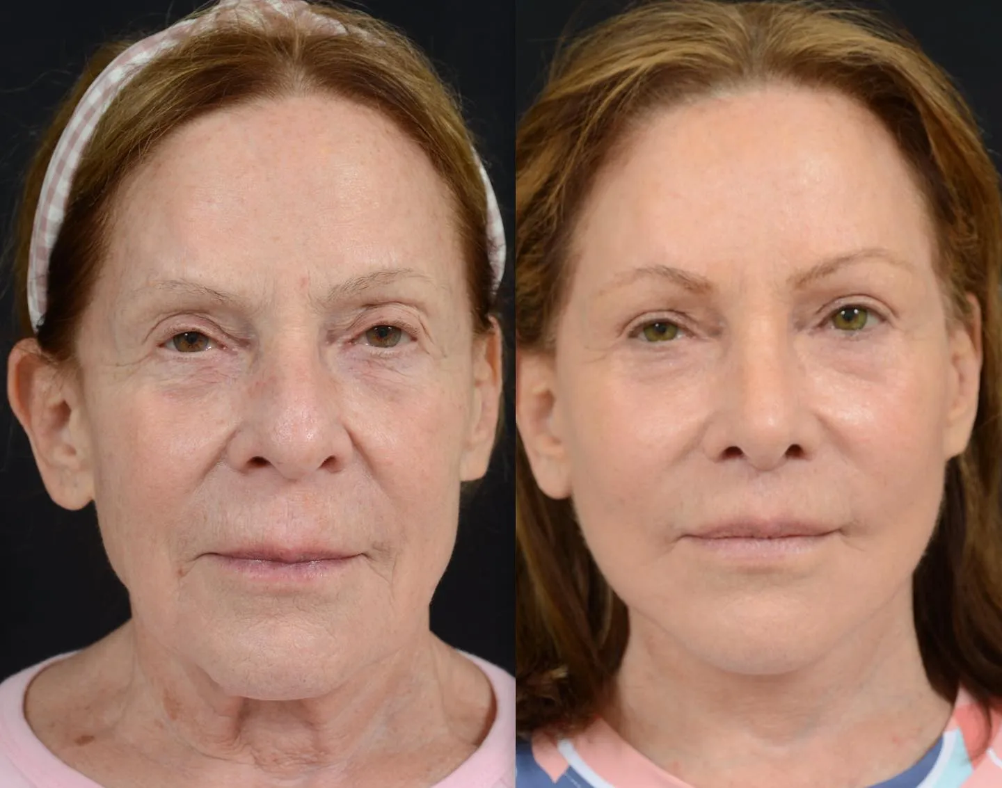 Facial Rejuvenation with Rhinoplasty