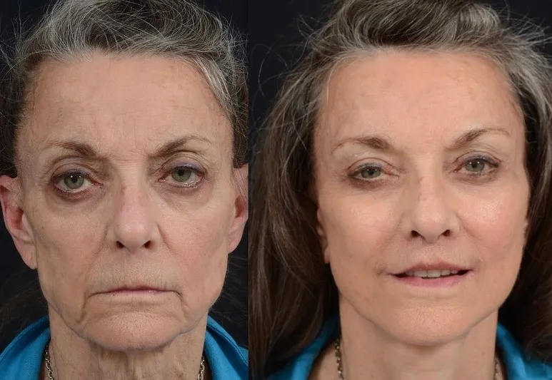 Facial Rejuvenation with Lip Lift
