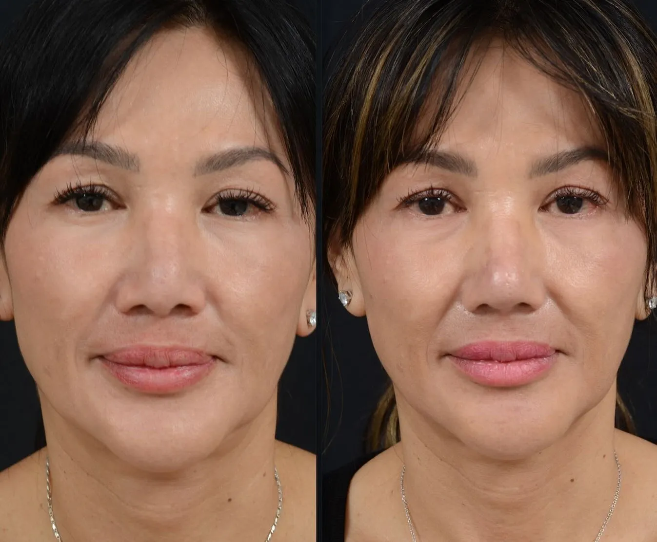 Rhinoplasty & Nasal Reconstruction