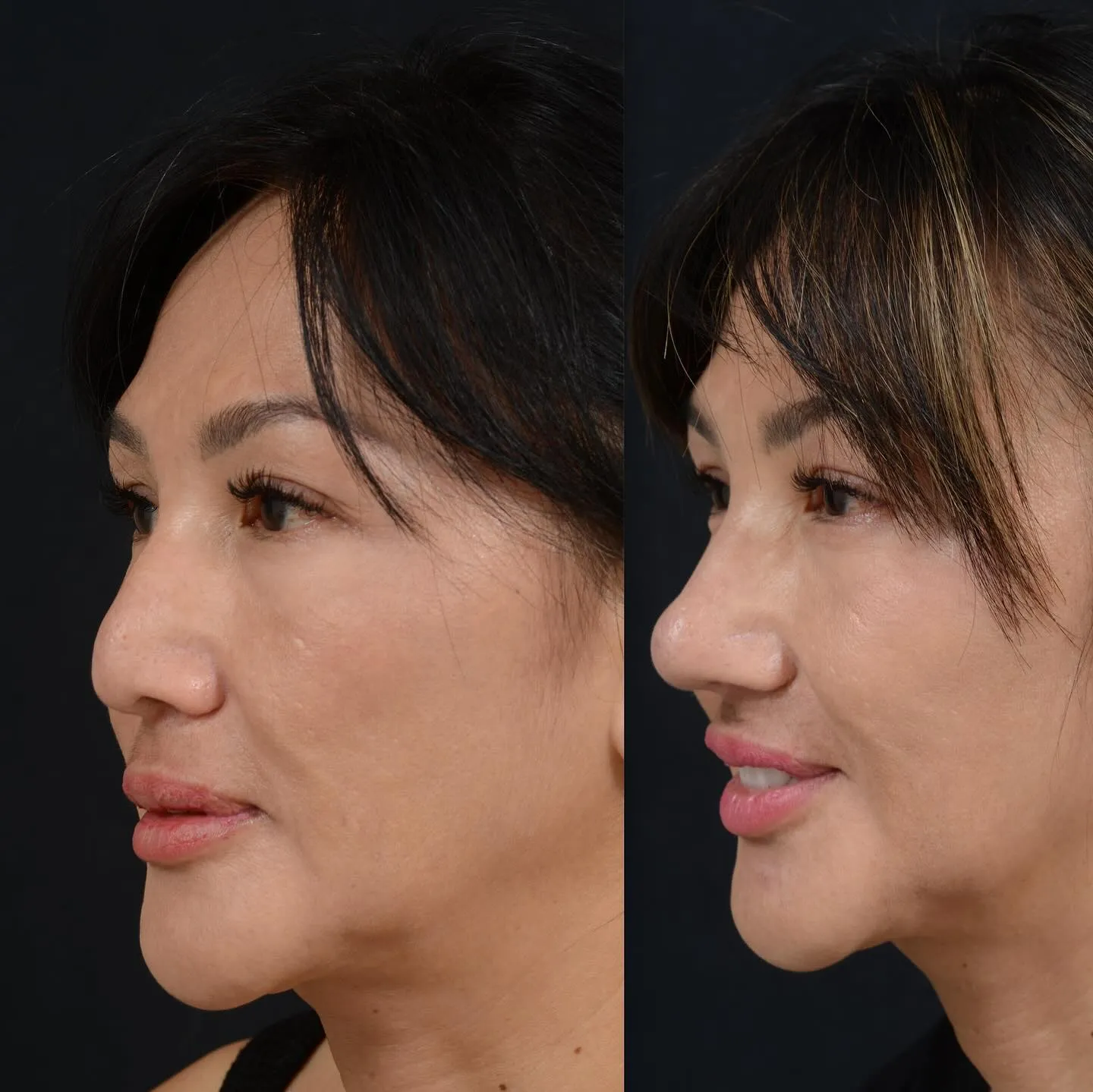Rhinoplasty & Nasal Reconstruction