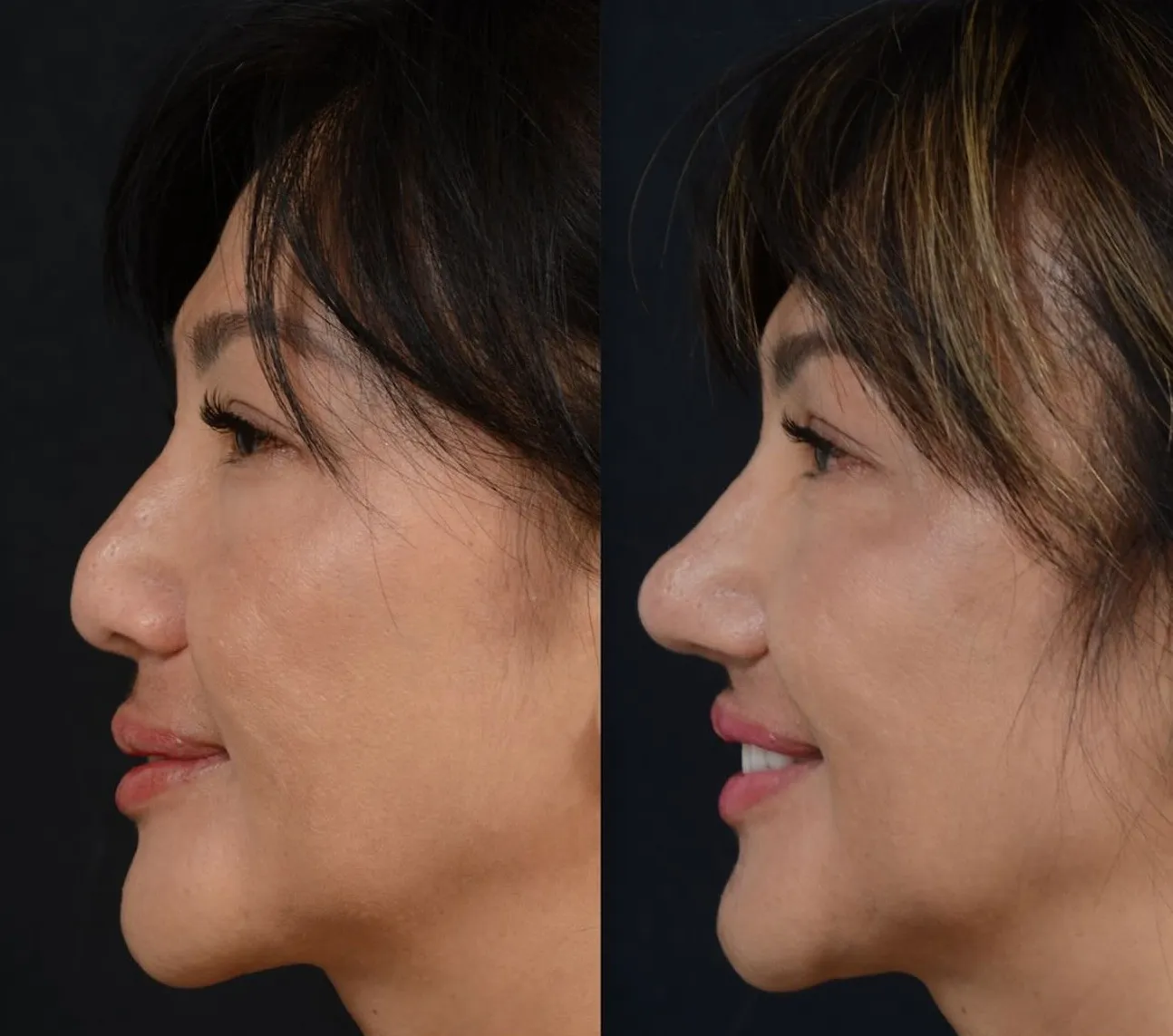 Rhinoplasty & Nasal Reconstruction