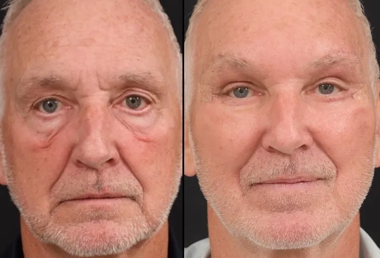 Blepharoplasty & Midface Lift