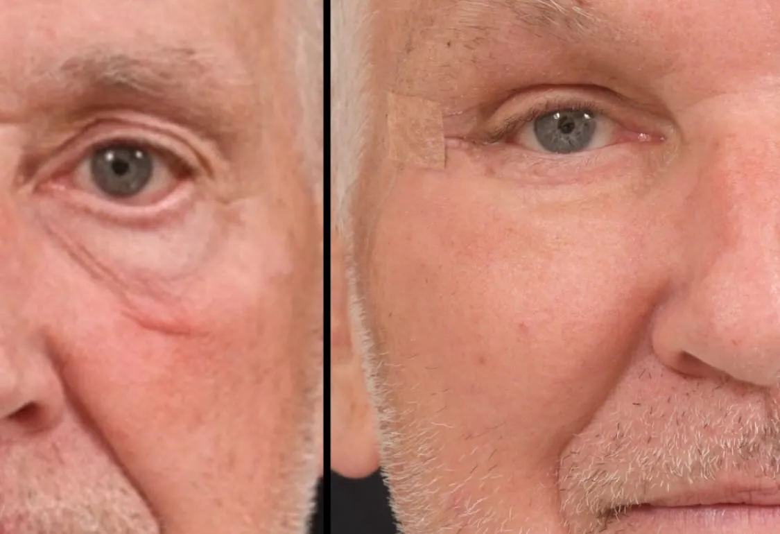 Blepharoplasty & Midface Lift