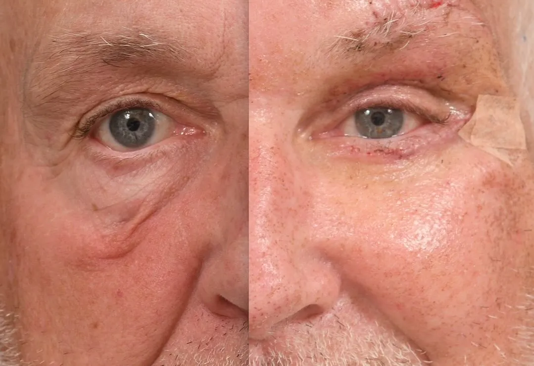 Blepharoplasty & Midface Lift