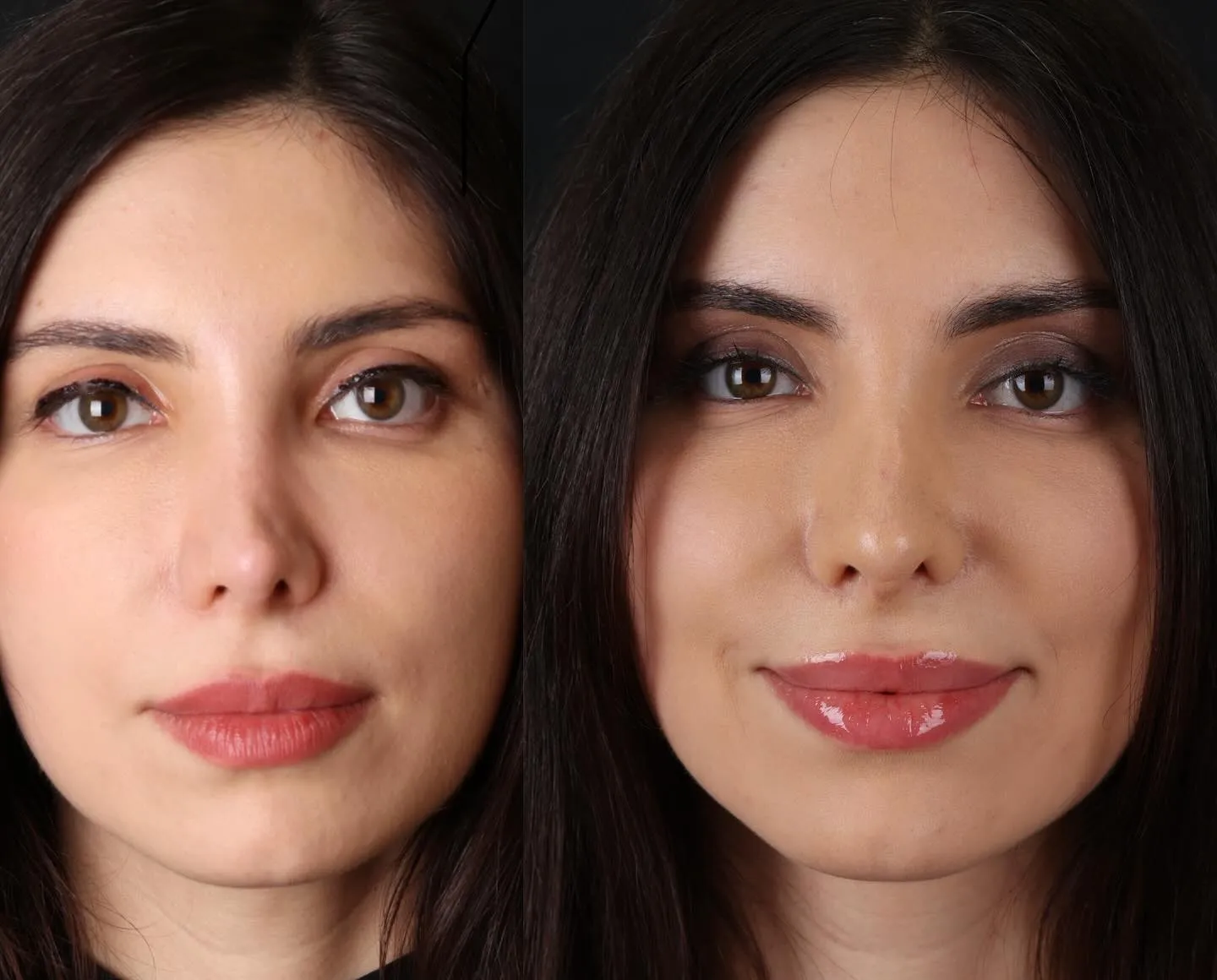 Revision Rhinoplasty