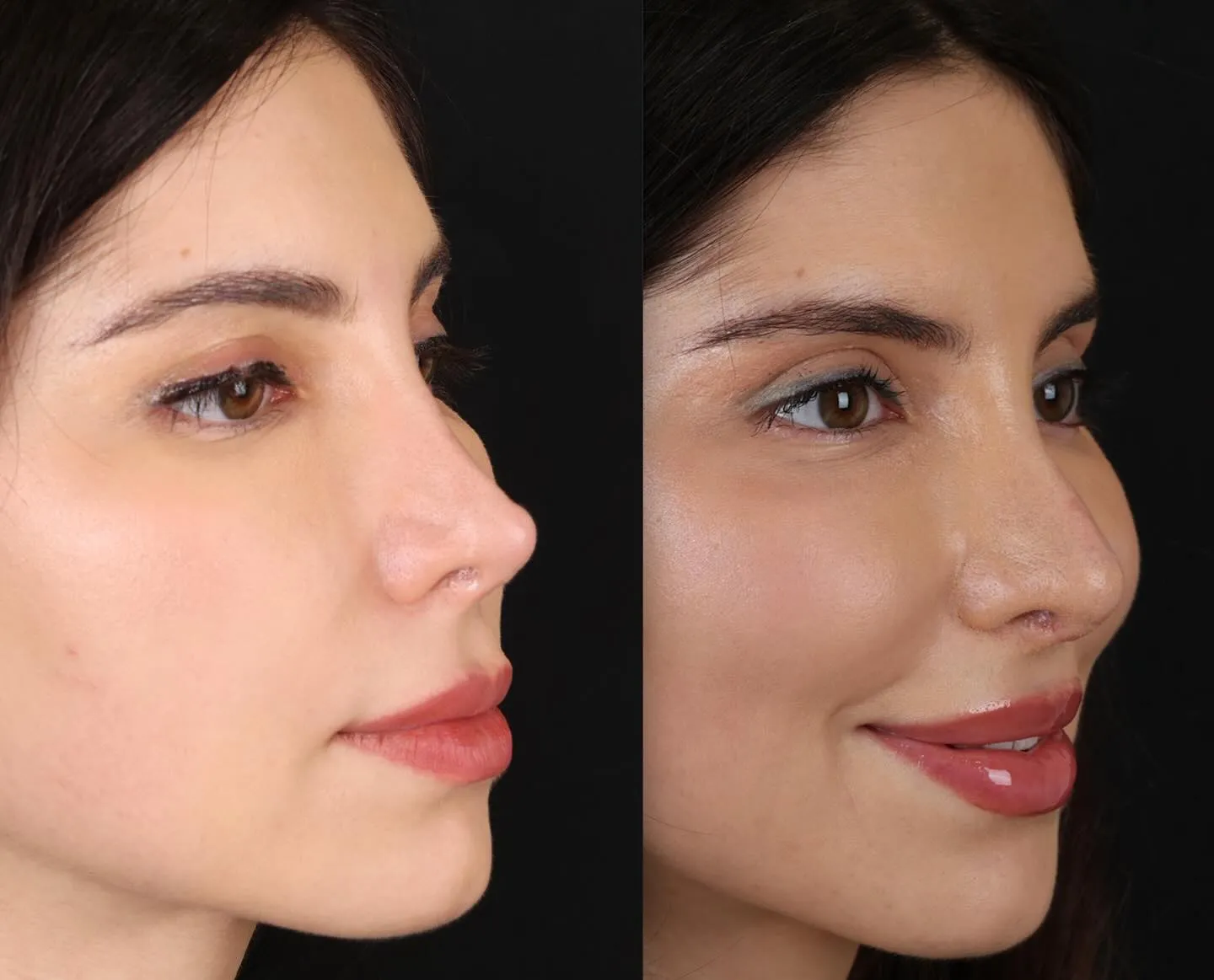 Revision Rhinoplasty